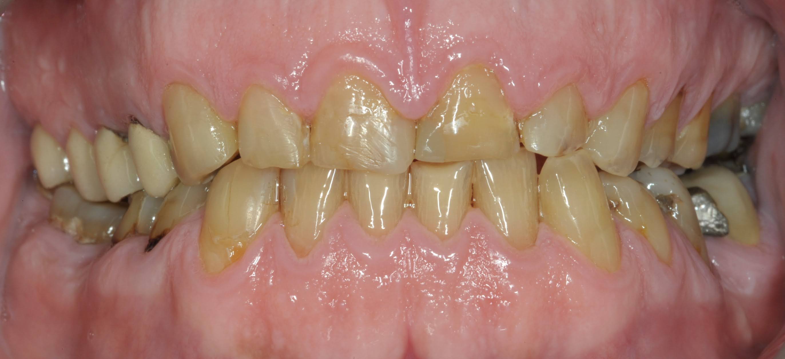 Carillas de composite - Antes