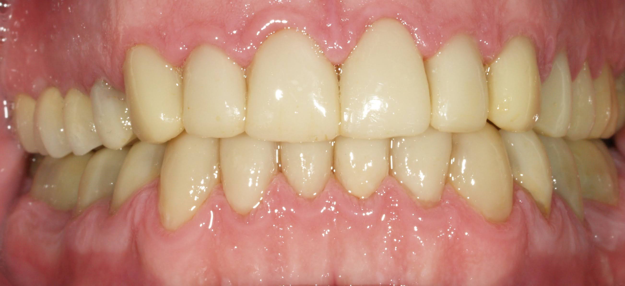 Carillas de composite - Después