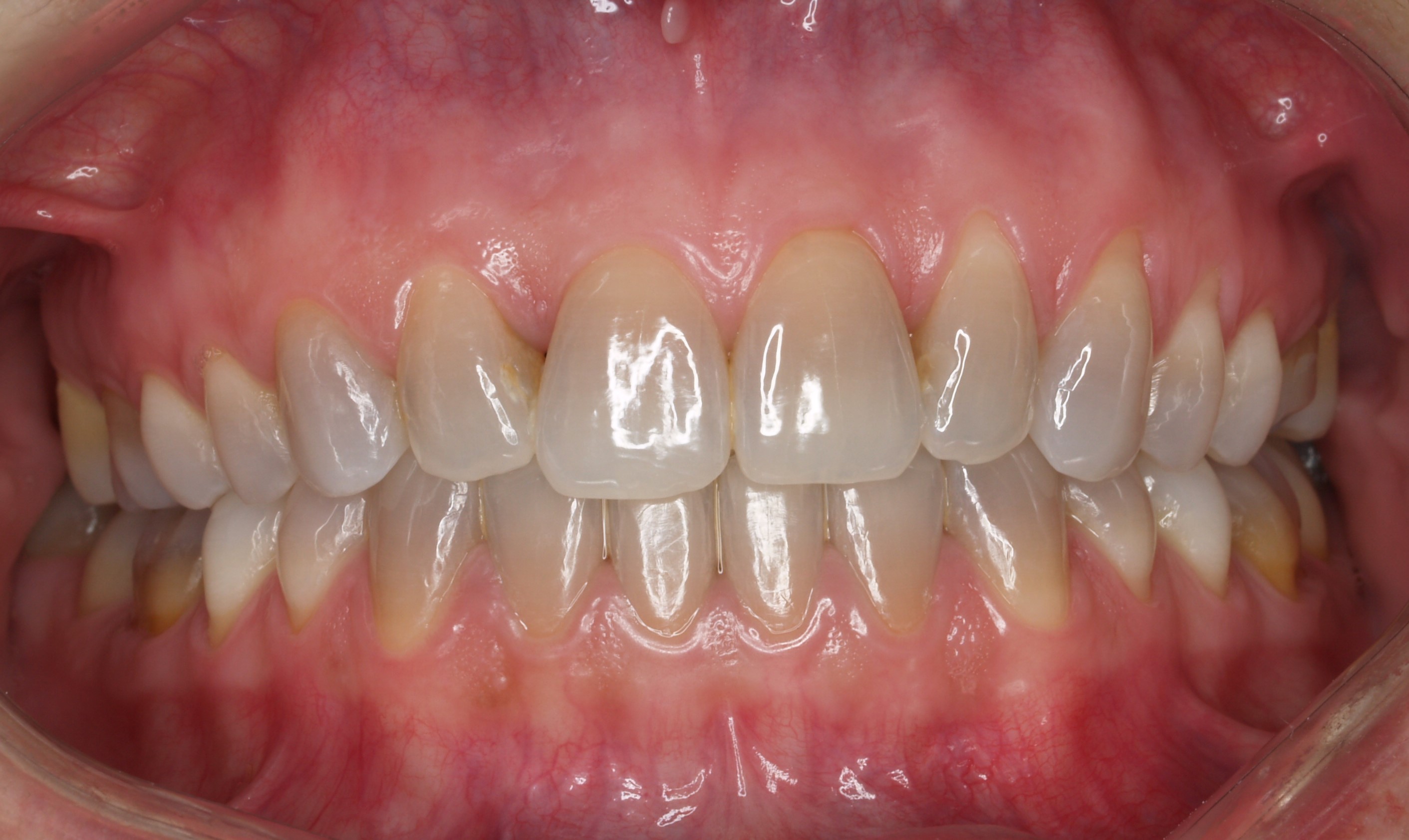 Carillas de porcelana - Antes