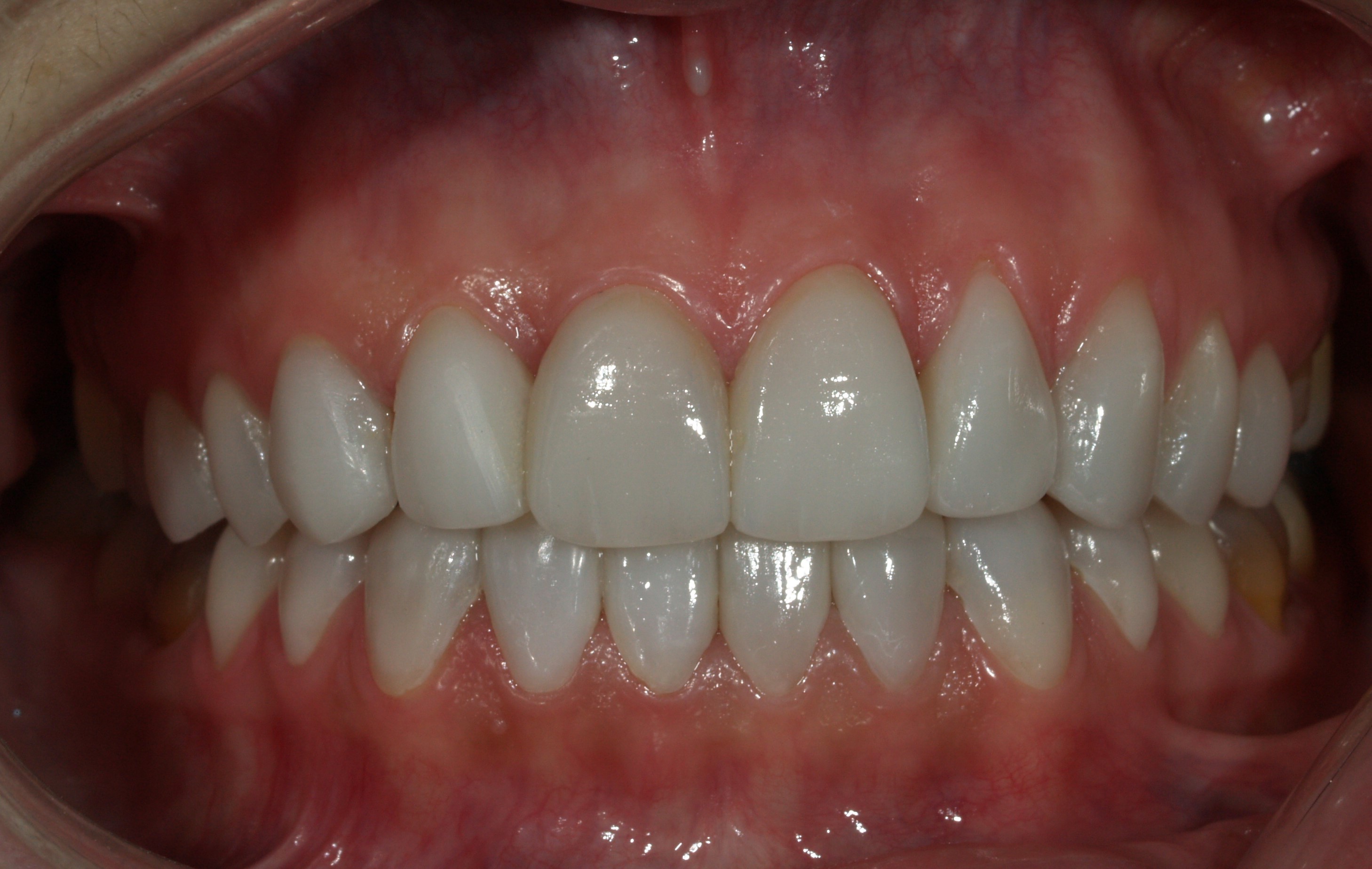 Carillas de porcelana - Después