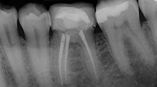 Endodoncia